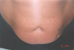 after using Barmon Stretch Mark Cream