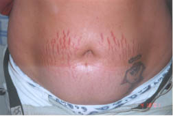 Stretch Marks - Before